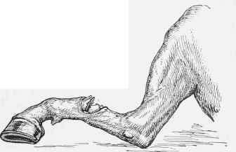 An Example of Compound Fracture.