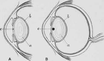 Capsular and Lenticular Cataracts.