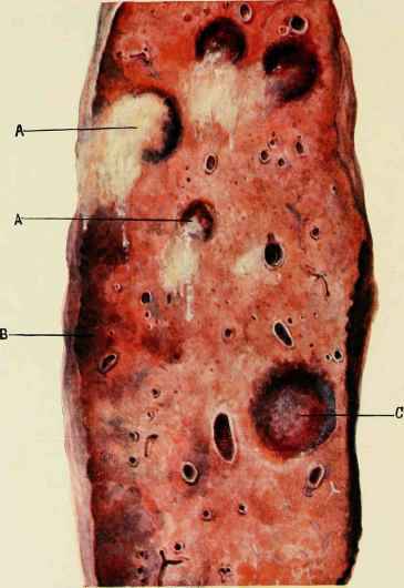 EMBOLISM OF LUNG.
