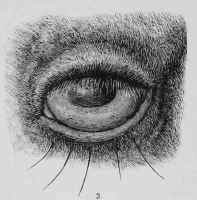 Entropium or In turned Eyelid.