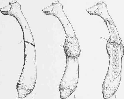 Fracture of First Rib of Horse (Inner Aspect).
