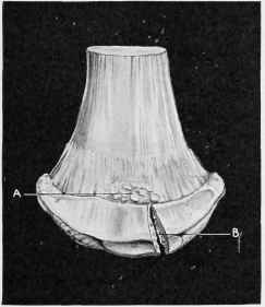 Fracture of Navicular Bone.