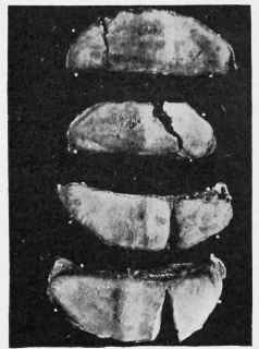Fracture of the Navicular Bone.