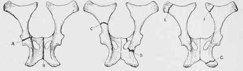 Fracture or the Pelvis.