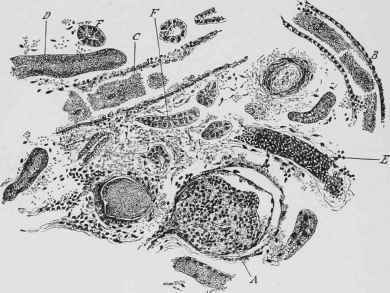 Section of Kidney of Horse affected with Haemo globinuria.