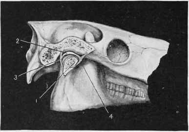 Temporo Maxillary Articulation.