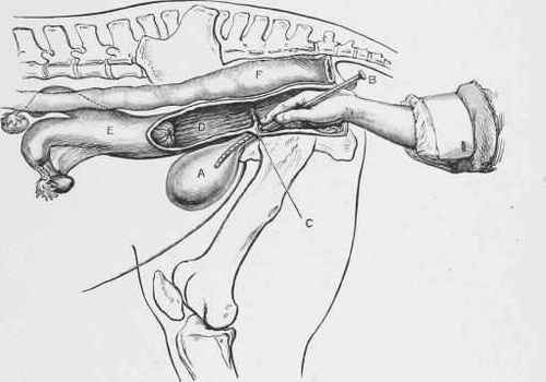 Insertion of Female Catheter.