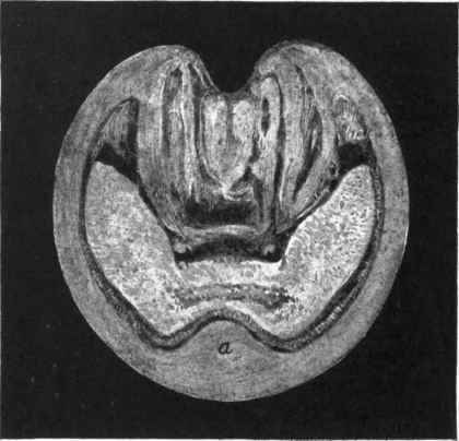 Keratoma or Horn Tumour Transverse section of foot showing Keratoma (a) in situ.
