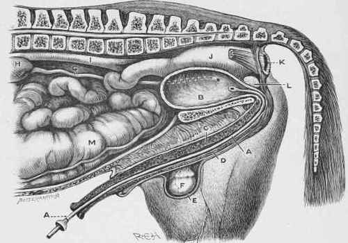 Retention of Urine   Catheter inserted.