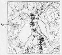Section from Upper Lobe of a Collier's Lung.
