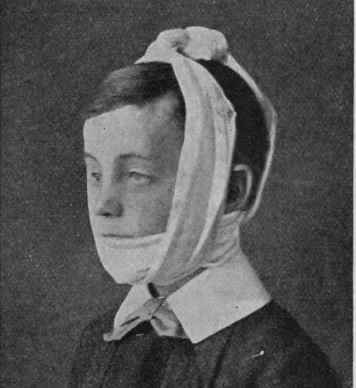Fig. 1. How to tie bandages for a fractured lower jaw