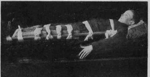 Fig. 6, The bandages for a fractured thigh with the improvised splints