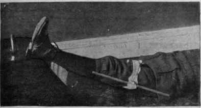 Tourniquet on thigh to control femoral artery