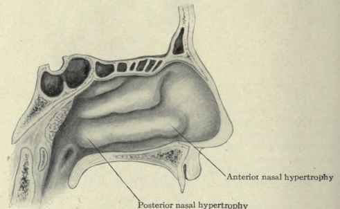 Fig. 120. View of anterior and posterior hypertrophies of the inferior turbinate.