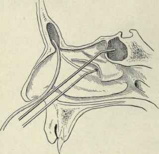 Fig. 125. Probes introduced into the frontal, maxillary, and sphenoidal sinuses. The anterior portion of the middle turbinate has been removed.
