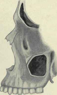 Fig. 126. Side view of the maxillary and frontal sinuses.