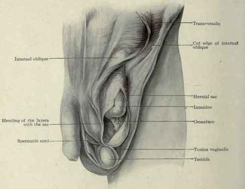 Fig. 397. The coverings of an acquired oblique inguinal hernia; from an actual dissection. The external and internal oblique have been divided along Poupart's ligament and turned inward exposing the transversalis.