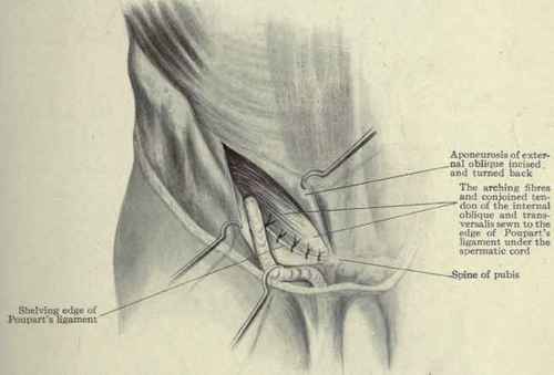 Fig. 398. Bassini's operation for the radical cure of oblique inguinal hernia.