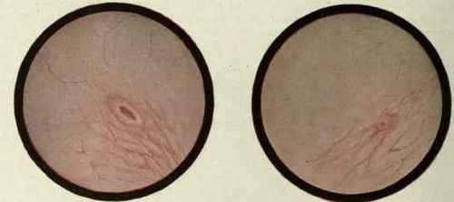 Fig. 453. The picture on the left demonstrates a normal mucous membrane and ureteral orifice. On the right the ureteral orifice will be observed to be small, round, atrophic, and functionless. (Drawn from a case of Dr. Benj. A. Thomas* by Mr. Louis Schmidt).