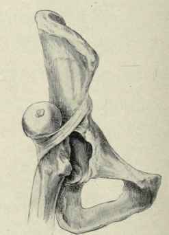 Fig,. 522.   Reversed dorsal luxation. (After Allis).
