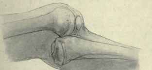 Fig. 553.   Subluxation of the knee from tuberculous disease showing the relation of the bones. (From an original sketch by the author).