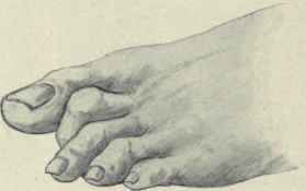 Fig. 602. Hammer toe. (From author's sketch).