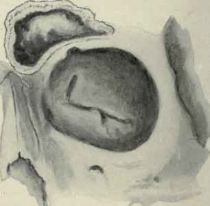 Figs. 123 and 124. Two views of the frontal sinus, showing variation in size in different individuals. The anterior wall has been cut away to expose the interior of the sinus.