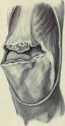 FlG. 551.   Fracture of patella, showing lateral tear of capsule.