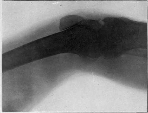 Ankylosed knee joint before ill advised forcible flexion