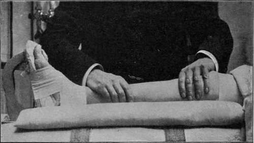 Fig. 2.   Massage in Recent Fracture of the Leg