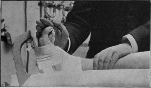 Fig. 4. Massage in Recent Fracture Of the Leg