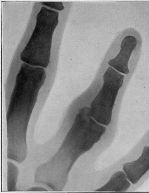 Fig. I.   A very exaggerated case of undetected fracture of the finger, showing deformity arising as in Fig. 12. The case came under observation about six months after the injury, as the appearance and character of the swelling around the part suggested tuberculosis.