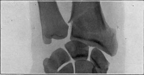 Fig. II. 'Motor sprain.' Comminuted fracture of lower end of radius, caused in the same way as fig. I. There was no deformity; the fracture had not been detected until shown by x rays three months after the injury.