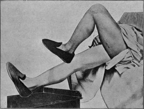 Massage and Early Movement in Recent Fractures