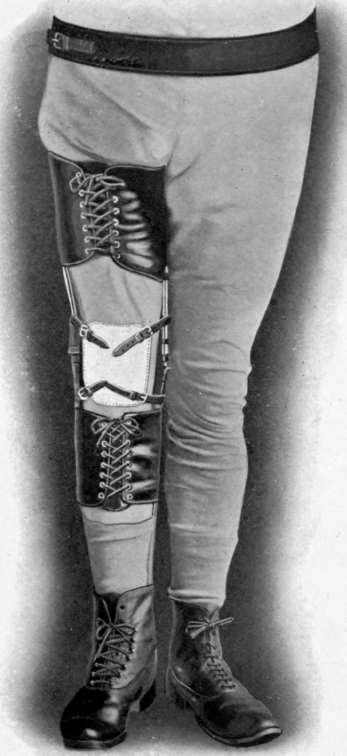 Plate V. Ernst's Instrument for Ambulatory treatment in slow or delayed union in fracture of the thigh.