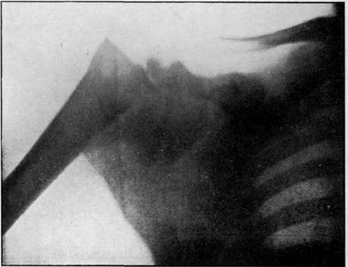 fracture of the humerus