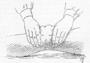 Fig. 105. Squeezing the Knee to reduce Swelling.