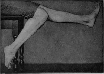 Fig. 104.   The final swinging exercise while sitting. Note the plantar flexion of the ankle with flexion of the knee, and dorsi flexion with extension of the knee