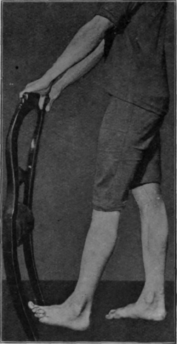 Fig. 106.   Second stage in swinging the knee. Note dorsi flexion with extension of the knee