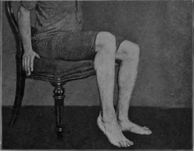 Fig. 107.   Second stage of the first sitting exercise. The heel is raised and lowered