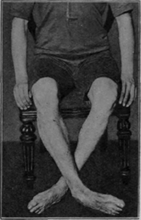 Fig. 110.   To illustrate the clawing exercise while sitting