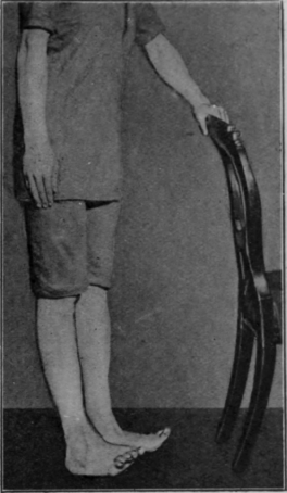 Fig. 121.   To illustrate the exercise in which the patient stands on the heels. Note that the inner borders of the feet are raised more than the outer