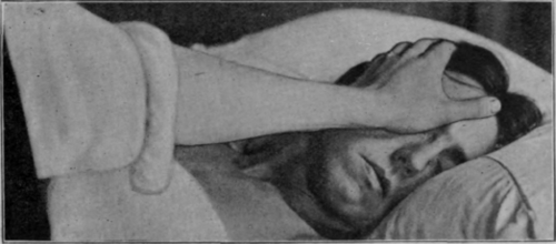 Fig. 139.   Head stroking: patient recumbent. The hand pivots round the ball of the thumb which rests over the eye