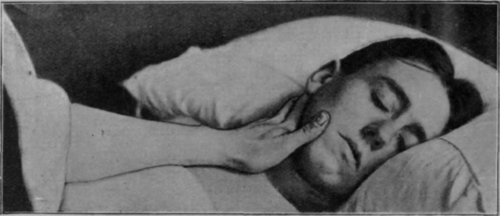 Fig. 140.   Head stroking: patient recumbent. The hand has supinated to reach the angle of the jaw