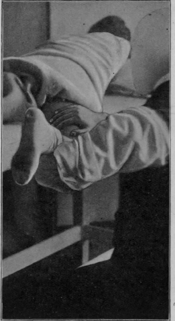 Fig. 145. To show position for treatment of a case of sciatica, the cure being well advanced