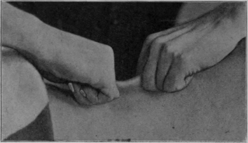 Fig. 148. To show dry cupping of the back by massage