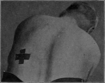Fig. 150.   To illustrate the position for a special breathing exercise when the patient has suffered from a left sided empyema. The hand of the masseur is placed over the area marked by the cross, and the patient endeavours to push the hand away during inspiration