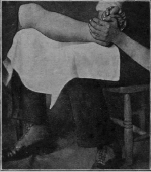 Fig. 151.   To show position for administering resistive exercises in metatarsalgia. The patient claws