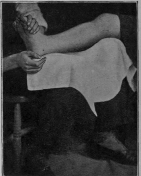 Fig. 152.   Showing an alternative exercise for metatarsalgia. The patient dorsi flexes the ankle and claws