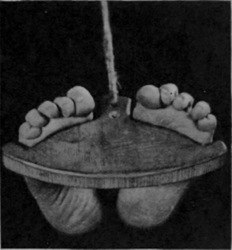 Fig. 154.   Capt Patterson's footboard in use. The cord is held in the patient's hands and he exerts the necessary tension. The knees are kept rigidly in full extension and the ankles in dorsi flexion